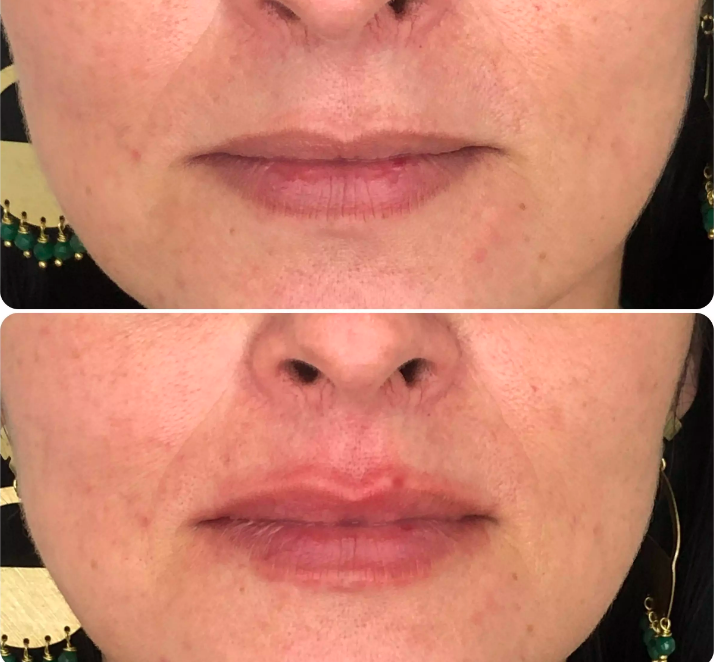 Comparativa antes y después del aumento de labios en Alicante