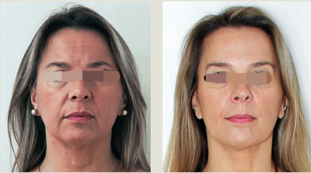 Consulta personalizada para tratamiento de Botox en Playa de San Juan, Alicante